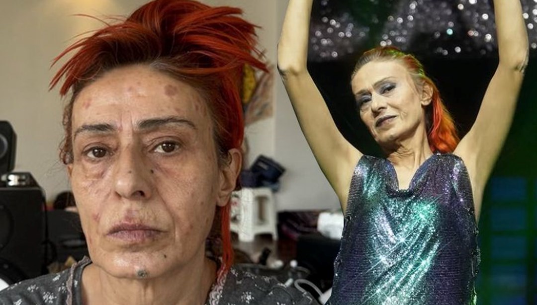 YÄ±ldÄ±z Tilbe’nin yÃ¼zÃ¼nde yanÄ±klar oluÅmuÅtu: OlayÄ±n perde arkasÄ±nÄ± anlattÄ±